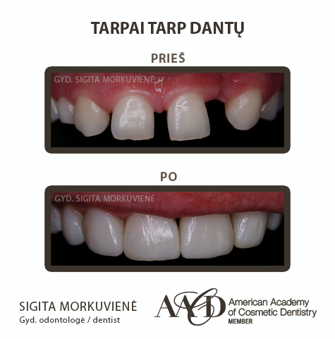 Gaps between teeth   